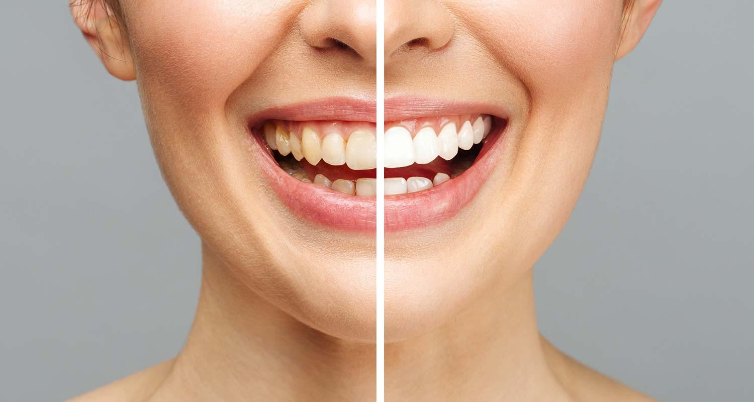 Before and after photo of the teeth before and after bleaching in Zurich-Enge Before and after photo of the teeth before and after bleaching in Zurich-Enge