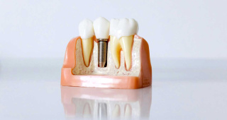 Model of a set of three teeth. One of the teeth has been restored with dentures. In the dental lounge you can get advice on dentures in Zurich-Enge.